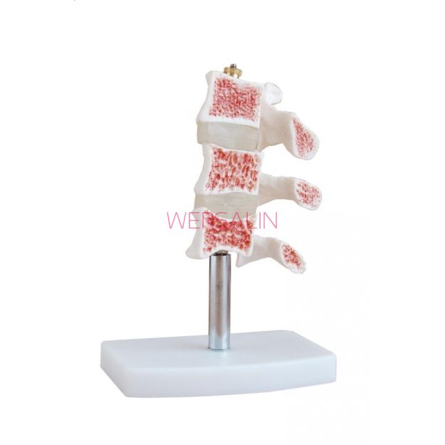Fragment osteoporozy model ma 134